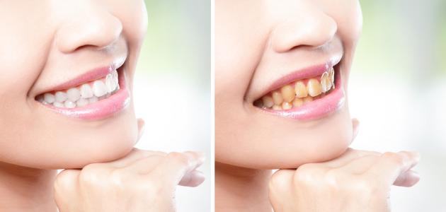 علاج صفار الأسنان