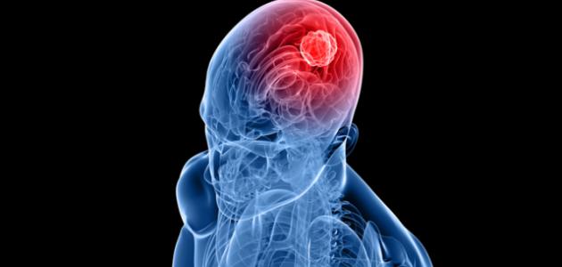 تشخيص الأورام السحائية الدماغية - فيديو