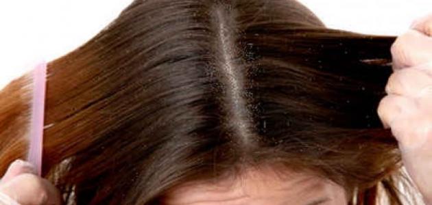 وصفة لعلاج قشرة الشعر