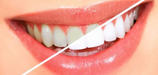 فوائد وأضرار تبييض الأسنان