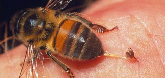 ما علاج لسعة النحلة