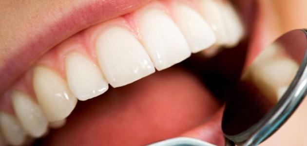 كيفية إزالة التسوس من الأسنان