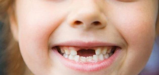 علاج تسوس الأسنان اللبنية عند الأطفال حروف عربي