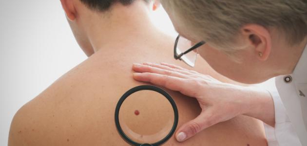 ما هي علامات سرطان الجلد