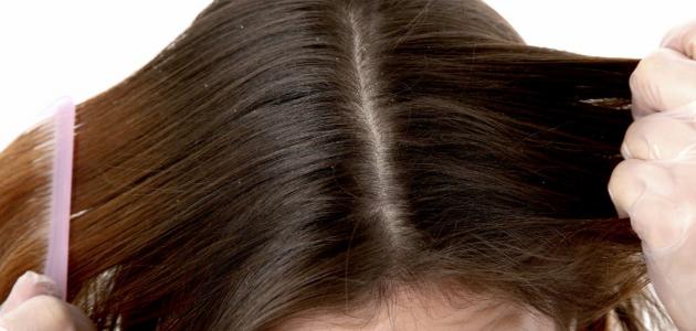 كيف يمكن التخلص من قشرة الشعر