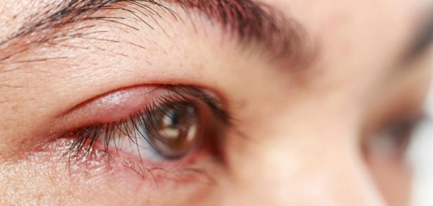 علاج التهاب حول العين