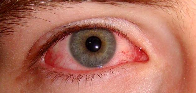 أمراض العيون وكيفية الوقاية منها