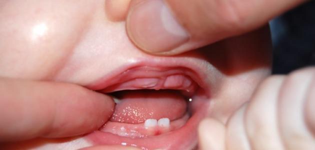 أعراض بروز أسنان الأطفال