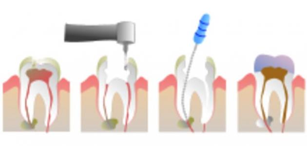 ما هو عصب الأسنان