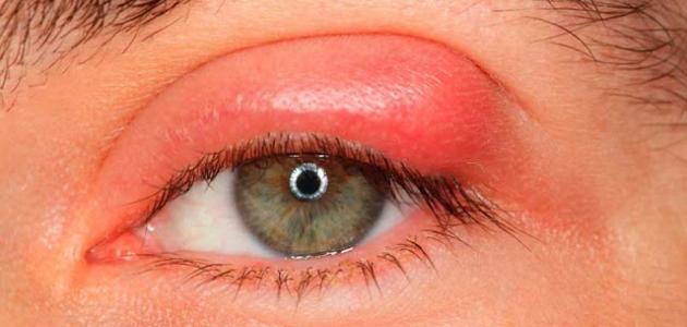 علاج حساسية جفن العين بالأعشاب