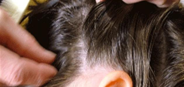 كيفية إزالة القمل والصيبان من الشعر