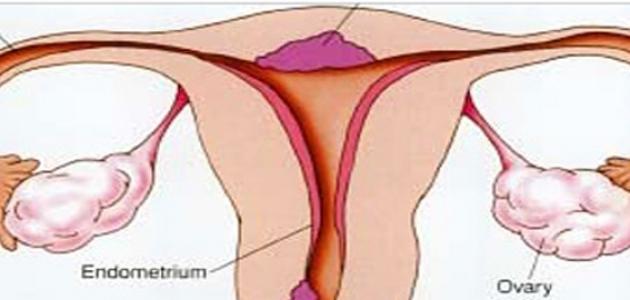 ما هي أعراض جرثومة الرحم