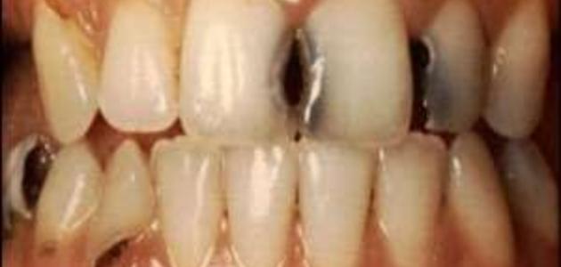 تحرك قوس ليدز  علاج تسوس الأسنان الأمامية - حروف عربي
