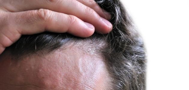 علاج الفطريات في الشعر