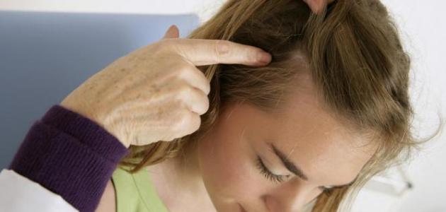 علاج فطريات الشعر عند الأطفال بالأعشاب