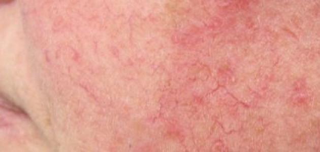 كيف تعالج حساسية الجلد
