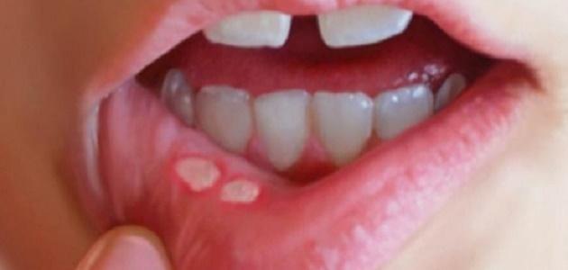 الفطريات في الفم