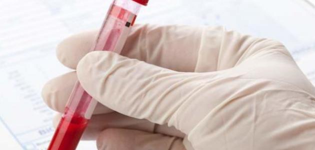 بحث حول مرض فقر الدم
