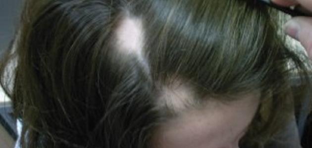 علاج ثعلبة الشعر
