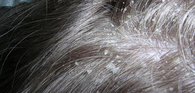وصفات للتخلص من قشر الشعر