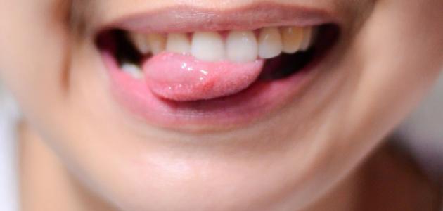 ما علاج الفطريات في الفم