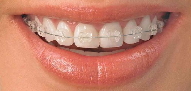 عيوب التقويم الشفاف للأسنان