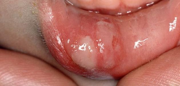 كيفية علاج تقرحات الفم