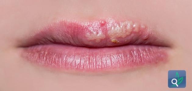 ما هو علاج فطريات الفم