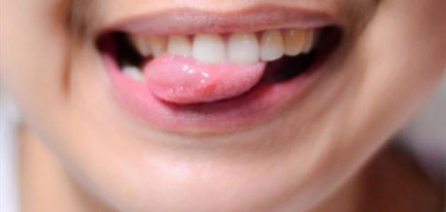 علاج فطريات الفم بالأعشاب للأطفال