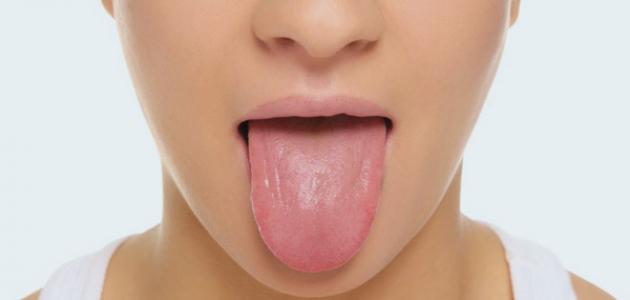 علاج الفطريات في الفم واللسان