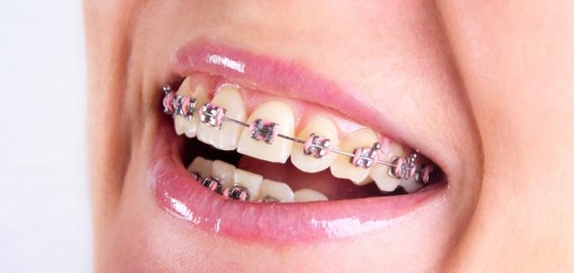 كيفية العناية بتقويم الأسنان