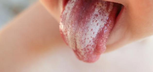 أسباب وعلاج فطريات الفم