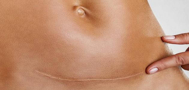 كيفية إزالة الكرش بعد الولادة القيصرية