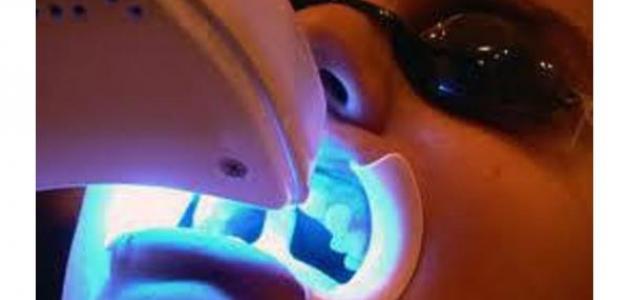 أضرار تبييض الأسنان بالليزر