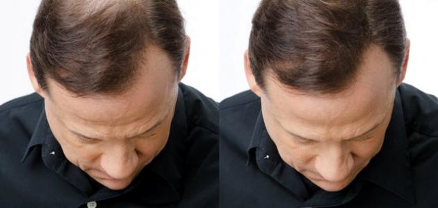 علاج تساقط الشعر والصلع عند الرجال