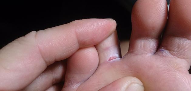 ما علاج الفطريات بين أصابع القدم