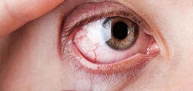 ما هو علاج جفاف العين