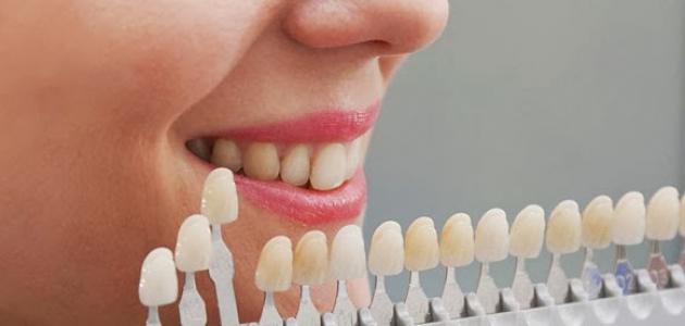 أنواع تبييض الأسنان - فيديو