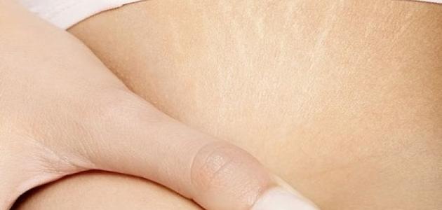 أسباب ظهور علامات تمدد الجلد