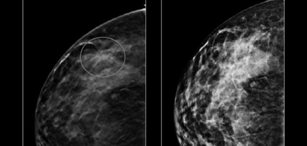 كيف اكتشف مرض سرطان الثدي