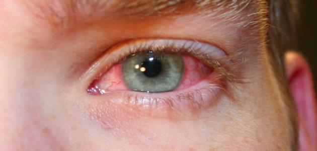 علاج اجهاد العين بالاعشاب