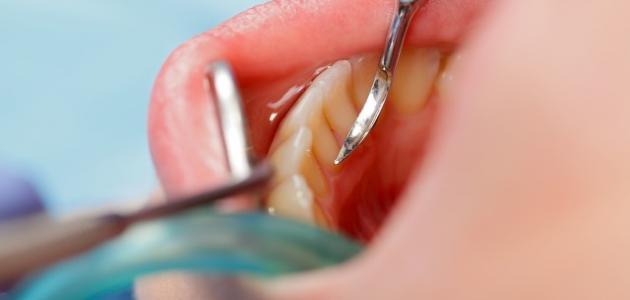 فوائد تنظيف الأسنان عند الطبيب