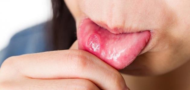 مرض الفطريات في الفم